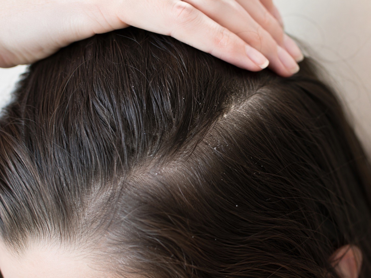Pellicules sèches ou grasses : comment les reconnaître avant de choisir son shampoing ?